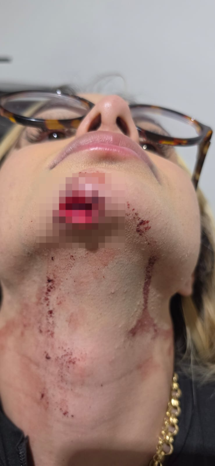 Ferimentos no queixo e no pescoço mostrados pela vítima após a agressão relatada