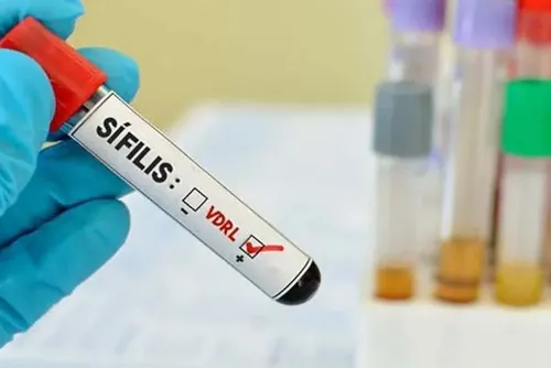 Profissional de saúde prepara teste rápido de sífilis em unidade de atendimento